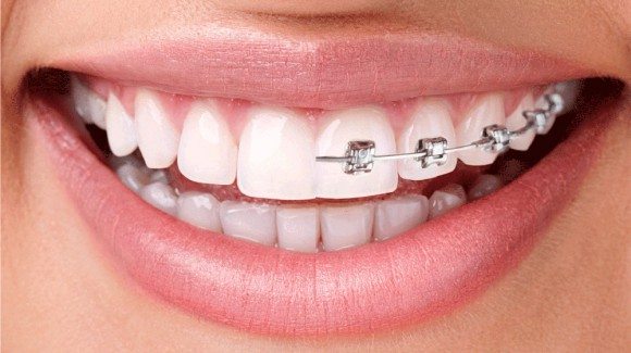 ortodontinis_gydymas